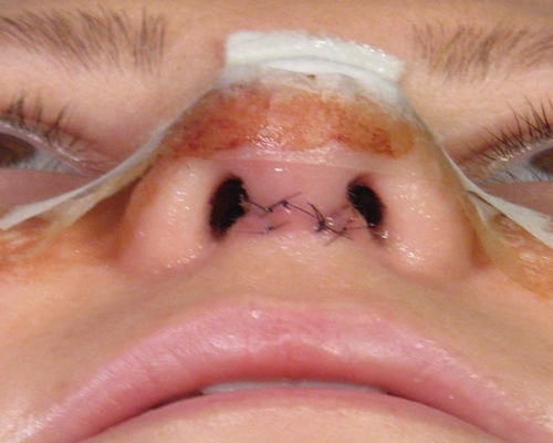 جای بخیه و زخم (اسکار) بعد از عمل بینی