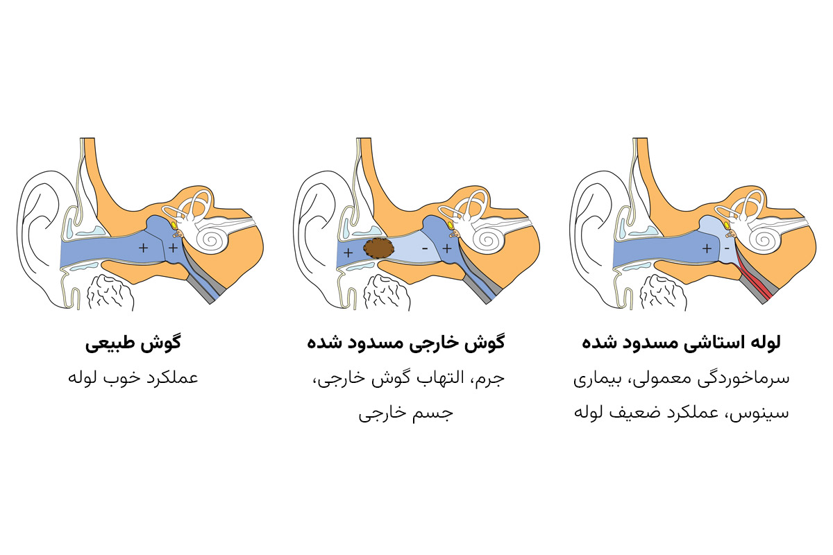 روش تشخیص باروتروما