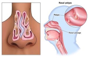 انحراف بینی و پولیپ بینی