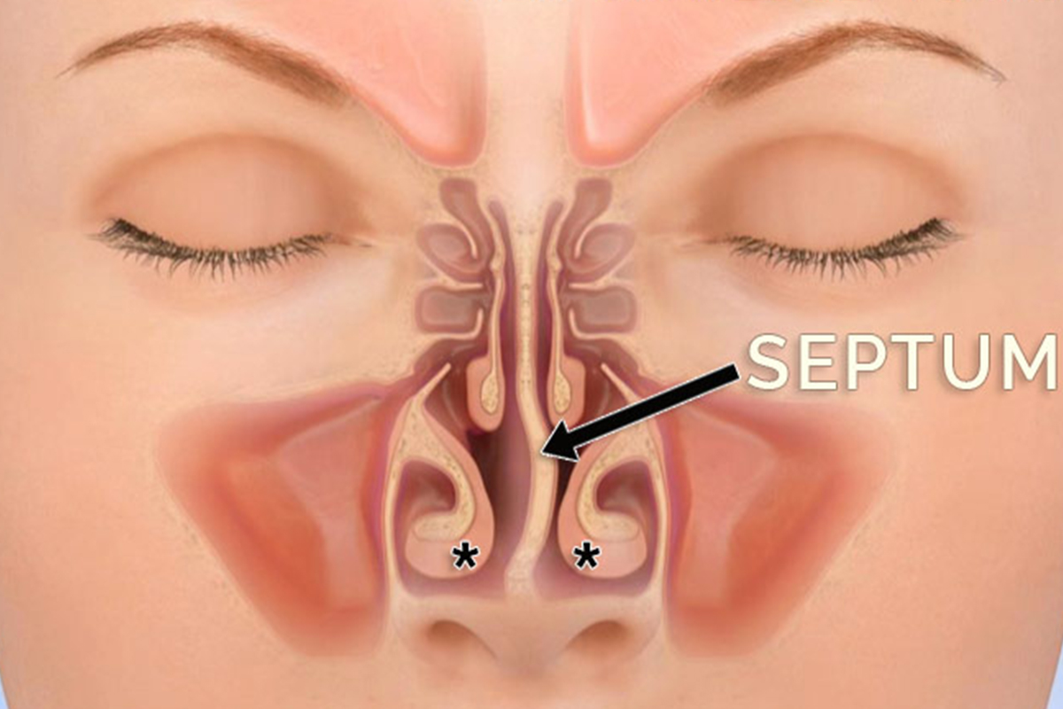 جراحی سپتوپلاستی چیست؟
