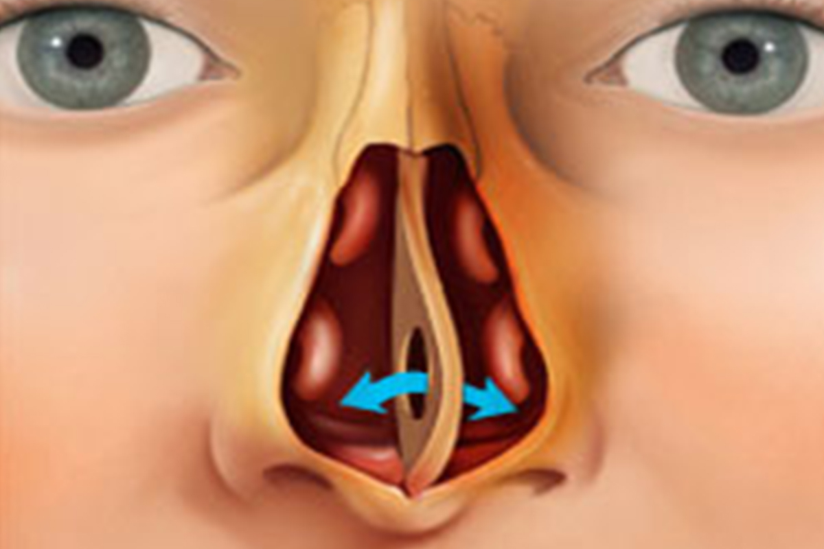 Signs of nasal septum perforation