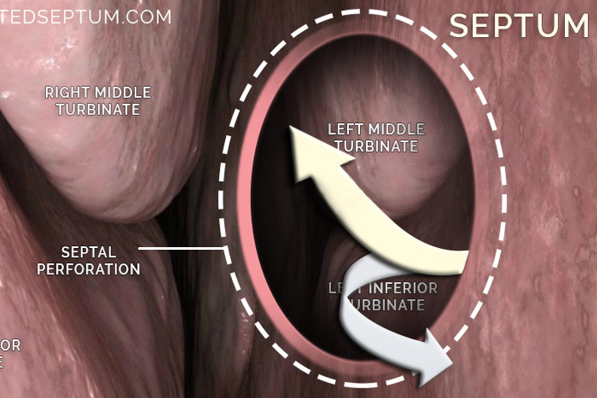 Common causes of nasal septum perforation