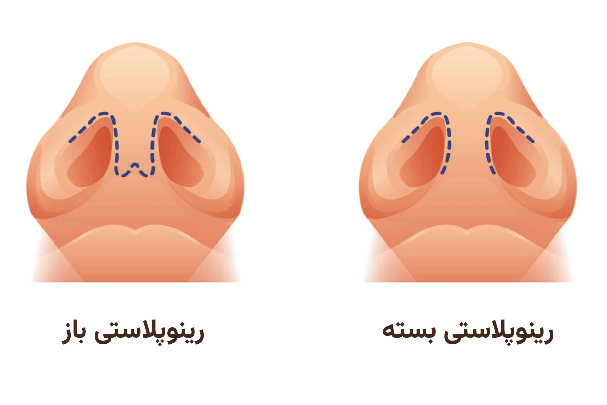 رینوپلاستی باز و بسته