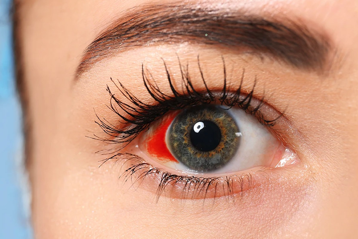 علائم قرمزی چشم بعد از عمل بینی