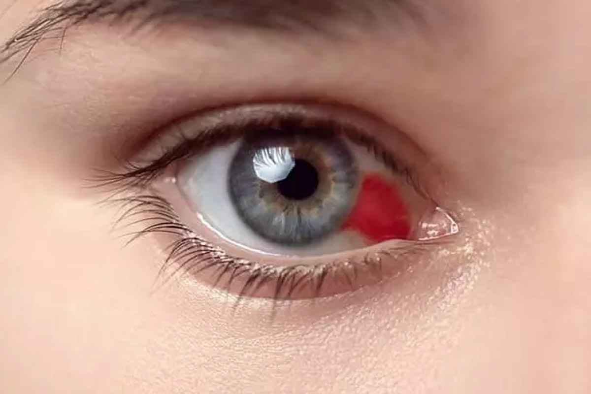 درمان قرمزی چشم بعد از عمل بینی