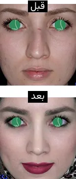 قبل و بعد جراحی بینی طبیعی