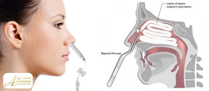 جراحی بینی بدون تامپون 
 یا فیتیله مزایای بسیاری از جمله تنفس راحت‌تر را برای بیمار به همراه دارد.