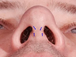 مراقبت از بخیه ها بعد از عمل بینی